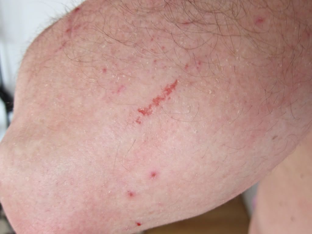 Scabies Right Elbow Fresh Scratch Photo by freshbytez Photobucket